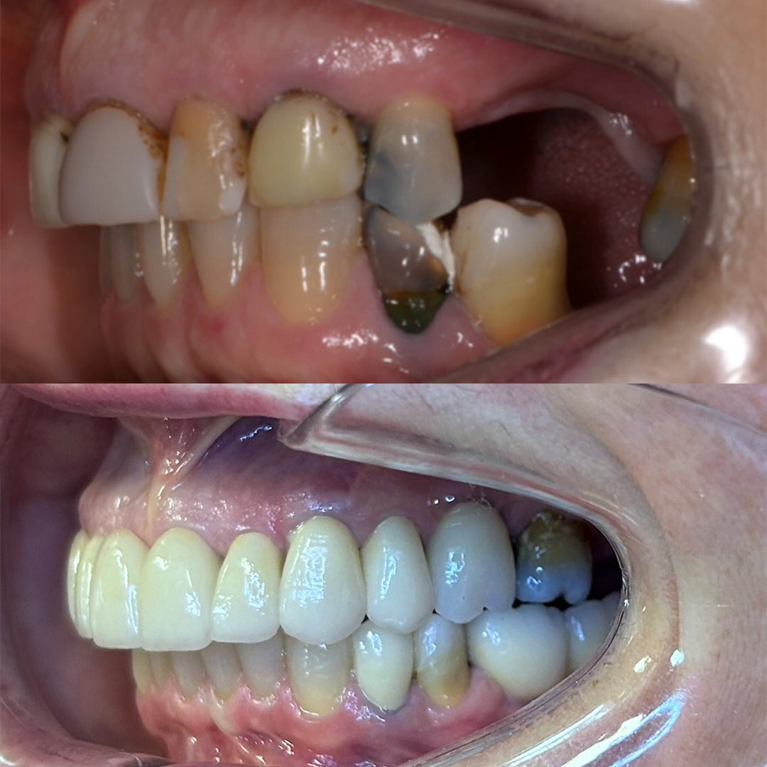 Dent01