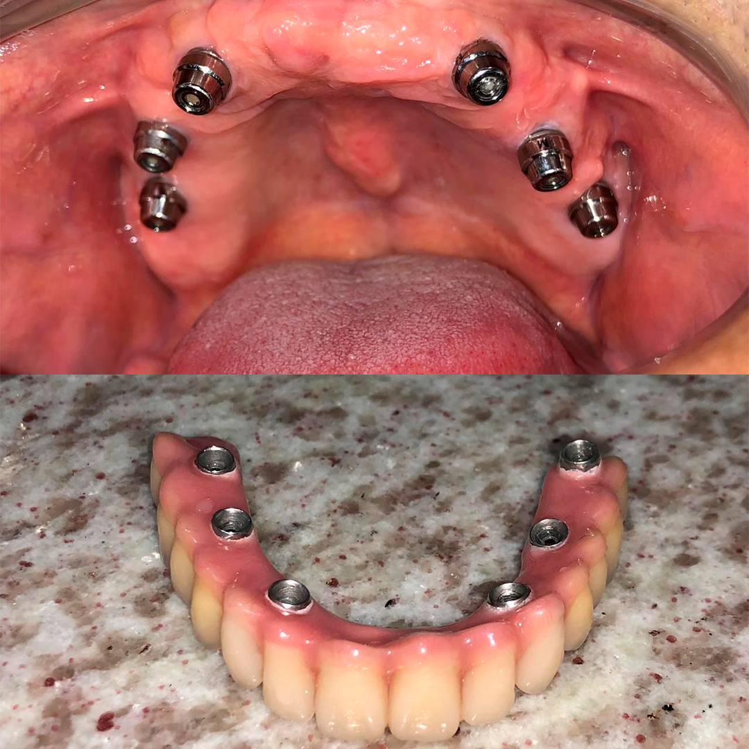 Dent02