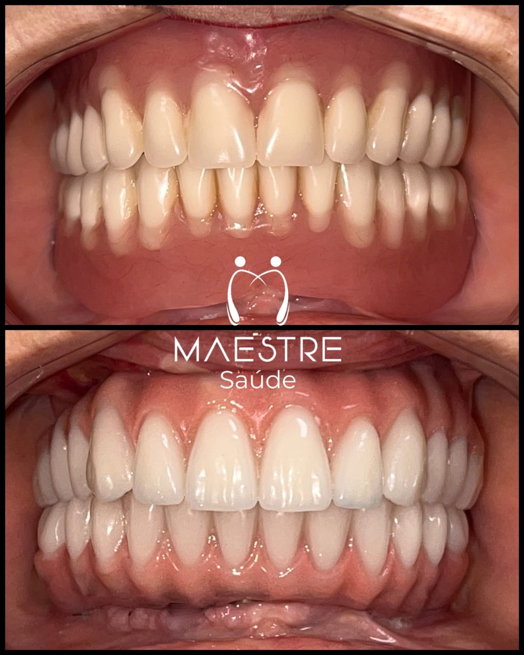 antes e depois Dirce