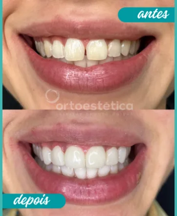 Antes e Depois 4 (1)
