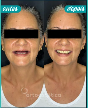 Antes e Depois 4 (2)