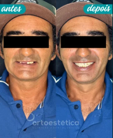 Antes e Depois 4 (3)