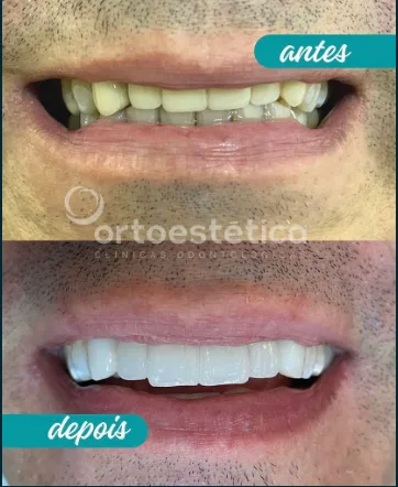 Antes e Depois 4